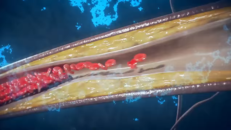 Restores blood flow, from the inside out.